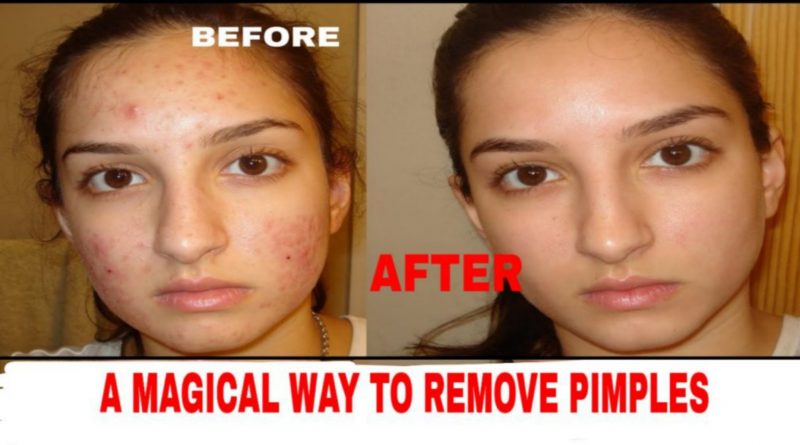 A Magical Way To Remove Pimples